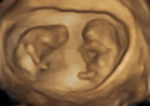 鄭家純曝寶寶10週時超音波，頭一上一下如太極。（圖／翻攝自鄭家純臉書）