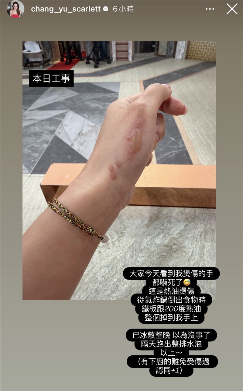 張宇遭到熱油燙傷。（圖／翻攝自IG）