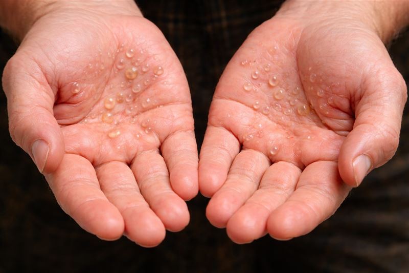 手掌若出現水泡，別以為只是濕疹，可能是梅毒警訊。（圖／AI製圖）