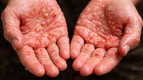 水泡,梅毒。（圖／AI製圖）