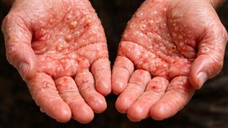 不是濕疹！男手掌起水泡中梅毒 醫揭5警訊