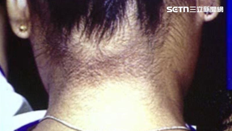 脖子上有圈黑黑的「黑色棘皮症」洗不掉，該症可能是糖尿病前兆。（示意圖／資料照）