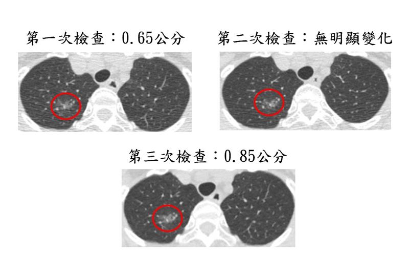 病人在第三次追蹤時，病灶已增長至0.85公分。評估後，接受微創手術切除。（圖／大千綜合醫院提供）