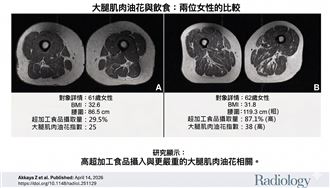 研究：愛吃超加工食品「大腿肌肉變A5和牛」！震撼對比照曝（圖／翻攝蔡明劼醫師臉書粉專 ）