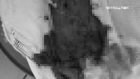 痔瘡術險死1800