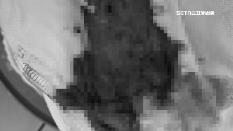 獨／花10萬醫美切痔瘡　6旬婦大出血送醫