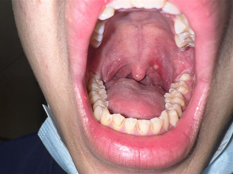 國內腸病毒6月攀高峰　醫界示警死亡率2成，籲滿2個月至未滿6歲之兒童，皆應評估接種腸病毒71型疫苗防護。（圖／施勝桓醫師提供）