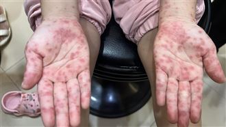 獨／腸病毒攀高峰！醫：1事未做死亡率2成