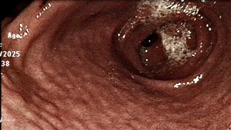 「1細菌」感染危機！醫：胃癌風險增10倍