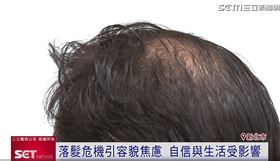 落髮危機引容貌焦慮！養髮慕絲關鍵成分「利尻昆布×瑞士赤松」掀關注