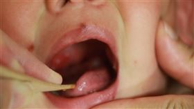 忽略這事…爸染皮蛇害不到1歲女兒長水痘　妻後來也中鏢！（圖／台中慈院提供）