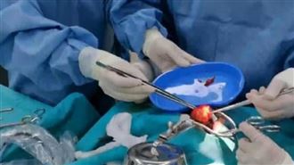 寄生雙胞胎卡氣管！6歲童夜夜打鼾原因曝