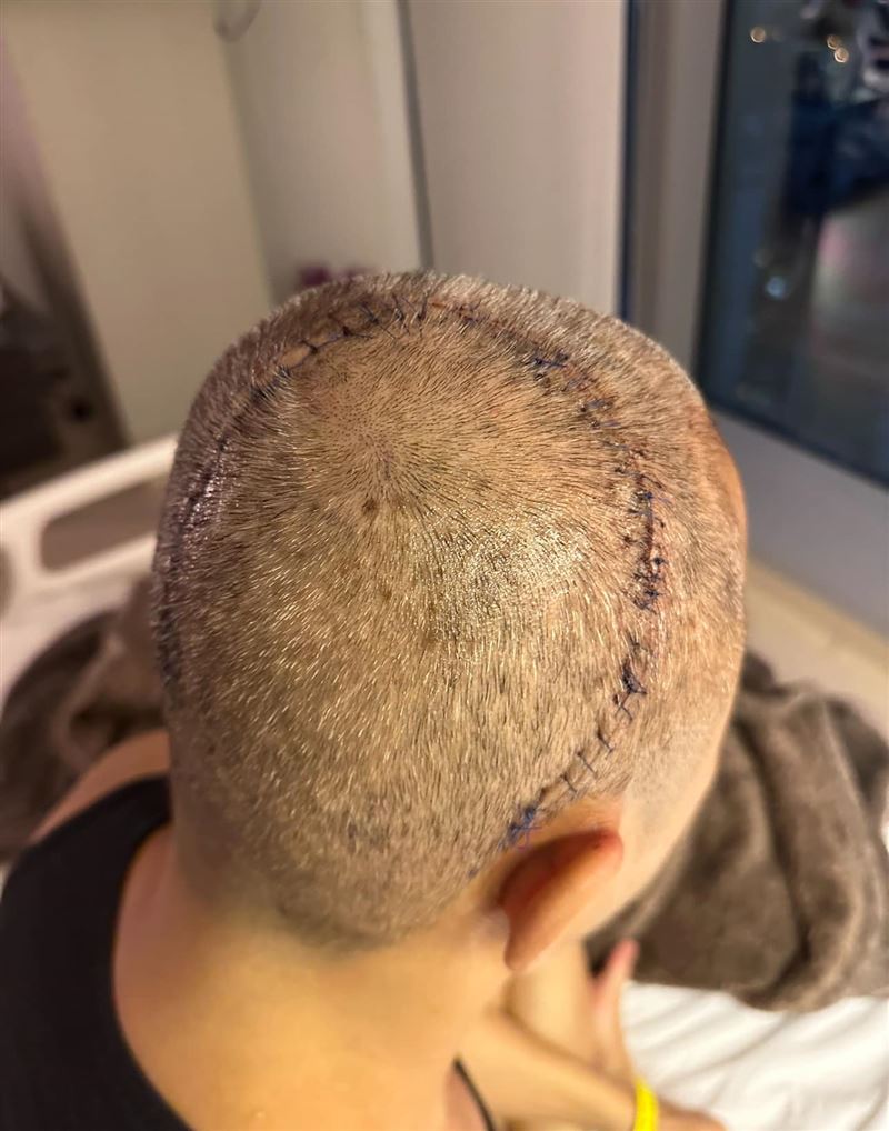「草蜢」蔡一傑曾經在臉書曬出自己開腦術後照片。（圖／翻攝自蔡一傑臉書粉專）