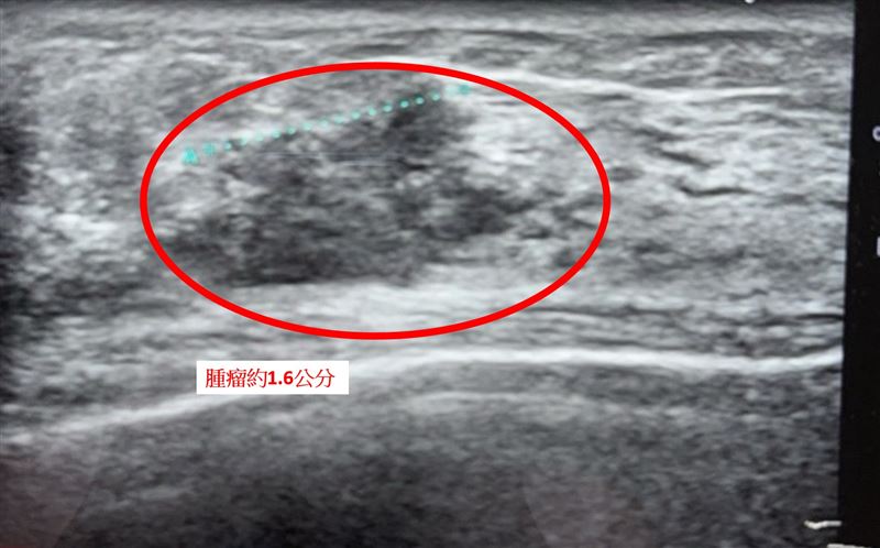 一名60歲乳管原位癌患者接受全乳切除與重建，術後恢復良好並重返工作。（圖／中國醫藥大學新竹附設醫院提供）