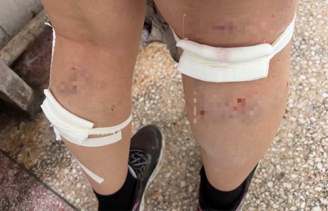 女大生身上有20多處傷口，雙腿上有10多處傷。（圖／翻攝微博）