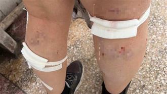 女大生遭流浪狗圍咬「全身20傷」患瘋狗病