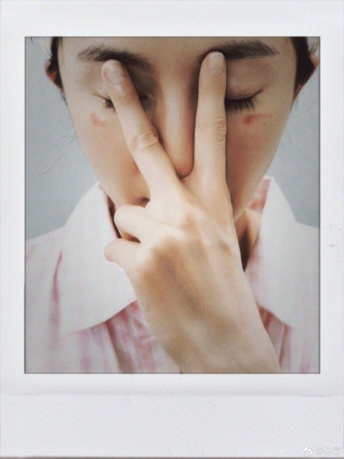 楊冪爆出眼窩遭蒸汽眼罩燙傷。（圖／翻攝自楊冪微博）