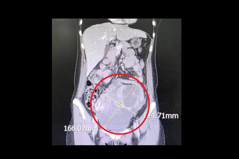病人就醫發現腹部直徑高達16公分的巨大腫瘤(紅圈處)，病理報告為罕見的同步性子宮內膜癌與卵巢癌。（圖／大千綜合醫院提供）
