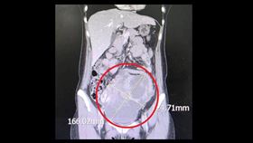病人就醫發現腹部直徑高達16公分的巨大腫瘤(紅圈處)，病理報告為罕見的同步性子宮內膜癌與卵巢癌。（圖／大千綜合醫院提供） 