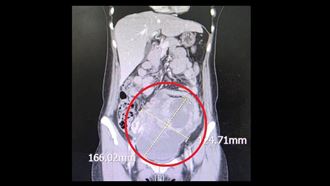 腹脹食慾差藏16公分巨瘤！44歲女同步雙癌