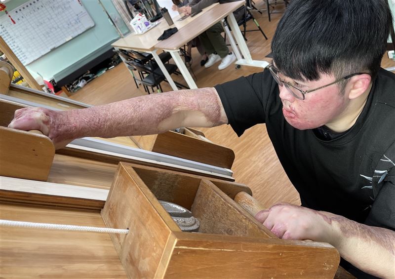 雅各大面積燒傷，復健1年後手肘伸直的角度大幅改善。(圖／陽光基金會提供）