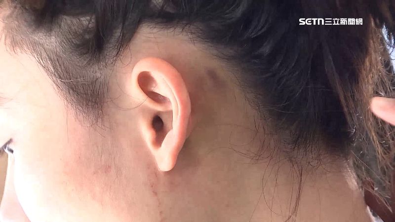 女子耳後明顯瘀青