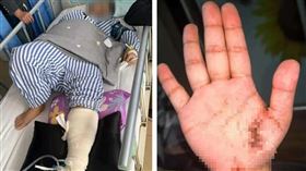邊充電邊滑手機遭電擊！女子全身多處灼傷進ICU　電流從手竄到腳（圖／翻攝自紅星新聞）
