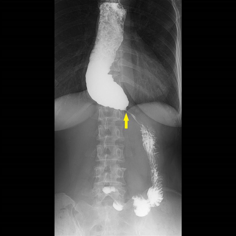 食道攝影顯示病人食道因食物過不去，上方的食道因為積壓而擴張，而下食道括約肌過緊，下方極度狹窄，如同鳥嘴般（黃箭號處）的狀態。（圖／台北慈濟醫院提供）