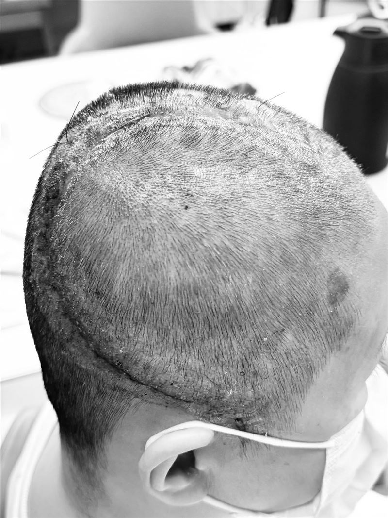 王月公開疤痕照。（圖／翻攝自臉書）