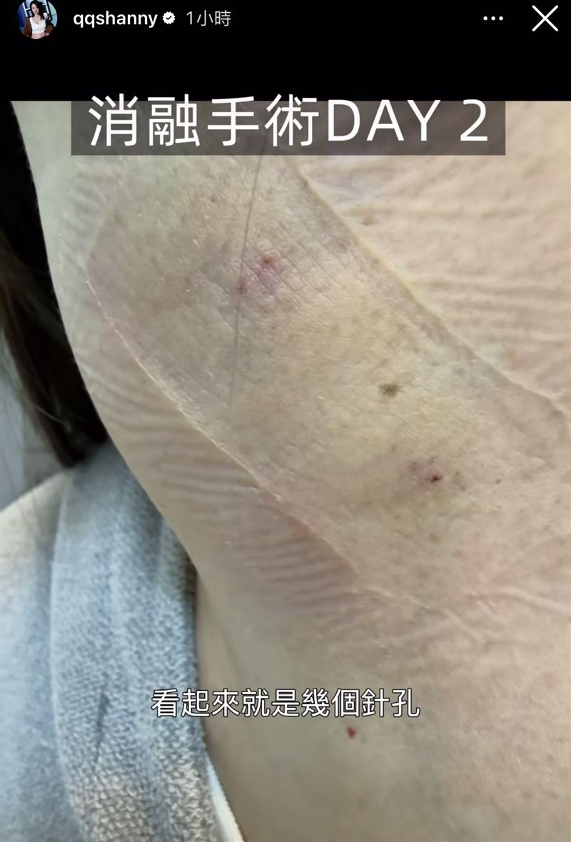 阿諾手術部位明顯發腫。（圖／翻攝自IG）