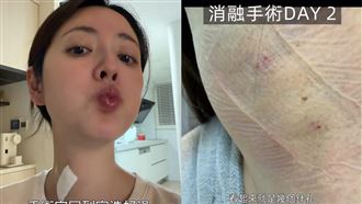 脖子長腫瘤壓迫食道　女星術後露面洩近況