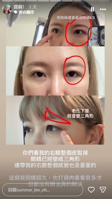 李懿分享接受手術的原因。（圖／翻攝自IG @summer_lee_oh）