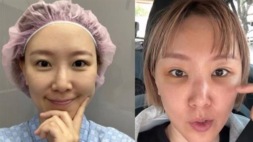 突入院動手術　女星崩潰曬「臉部慘腫照」