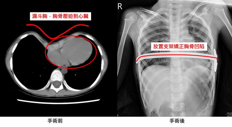 9歲童診斷為「大峽谷型」漏斗胸。（圖／中國醫藥大學新竹附設醫院提供）