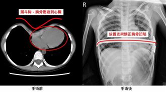 運動易喘注意　9歲童竟是大峽谷型漏斗胸