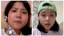 山豬妹突住院裝人工血管　原因曝光網讚爆