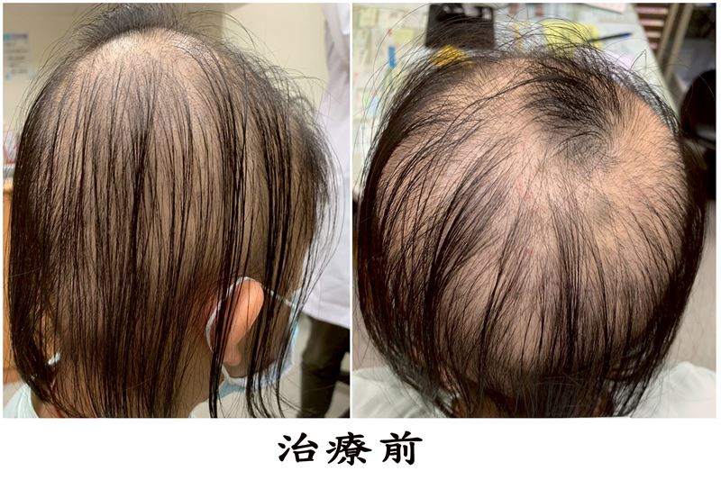 10歲女童罹圓形禿，掉髮達八成，遭同儕嘲笑一度想休學，經三年治療與陪伴，頭髮幾乎恢復，逐漸重拾自信與笑容。（圖／大林慈濟醫院提供）