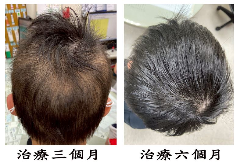 大林慈濟醫院皮膚科醫師林騰立指出，圓形禿為自體免疫疾病，恐影響外觀與心理，兒少易受霸凌。經治療與追蹤可改善，但仍有復發風險。（圖／大林慈濟醫院提供）