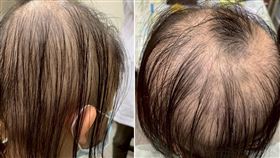 10歲女童罹圓形禿，掉髮達八成，遭同儕嘲笑一度想休學，經三年治療與陪伴，頭髮幾乎恢復，逐漸重拾自信與笑容。（圖／大林慈濟醫院提供）
