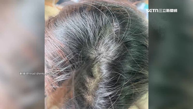 學生頭被藍鵲攻擊成傷。(圖/翻攝自Threads @sherry_park)