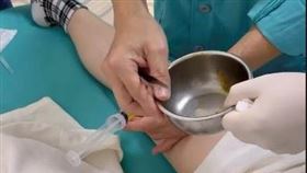 醫生用針筒幫楊千霈抽出膝蓋積水，讓她痛到叫出來。（圖／翻攝自IG @pinkbabe0309）