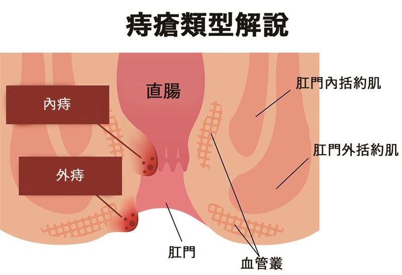 長時間蹲廁所會導致肛門靜脈曲張，形成痔瘡。（圖／澄清醫院提供）