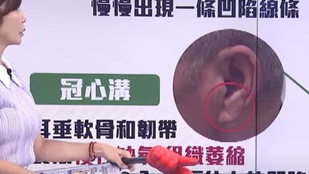 耳垂若出現一條傾斜的摺痕，可能與心臟冠狀動脈疾病有關。(圖／取自《醫點不誇張》)