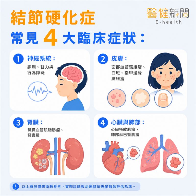 世界結節關懷日 / 結節性硬化症常見4大臨床症狀！（圖／醫健新聞網提供）