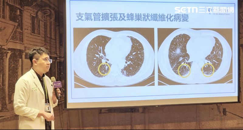 台南70歲翁易喘乾咳就醫「肺如菜瓜布」，醫呼籲：3大警訊儘速就醫。（圖／奇美醫院提供）