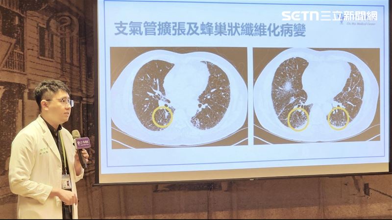 70歲翁易喘乾咳就醫「肺如菜瓜布」傻眼