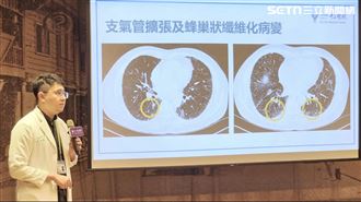 70歲翁易喘乾咳就醫「肺如菜瓜布」傻眼