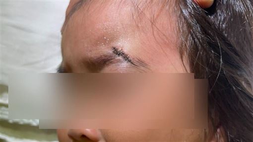 獨／台中幼兒園長愛犬暴走　2歲女童破相