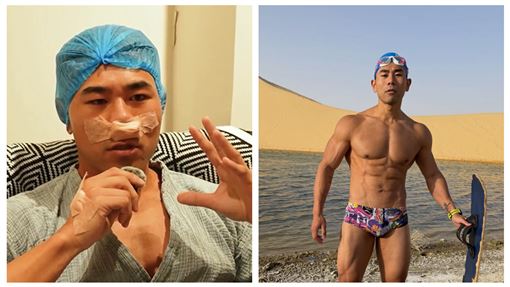 79萬Peeta葛格突開刀　真實病因曝光