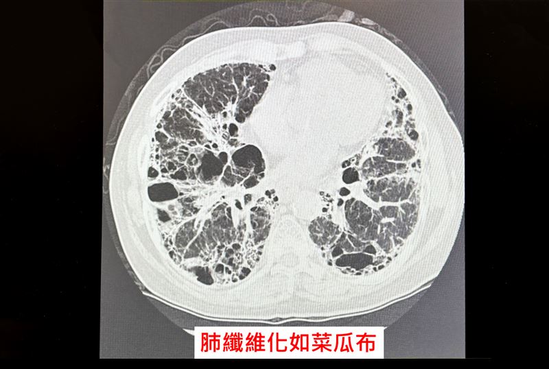 老翁過去一年總覺得喘吁吁，並伴隨咳嗽超過一個月，就醫後經診斷為「肺纖維化」。（圖／中國醫藥大學新竹附設醫院）